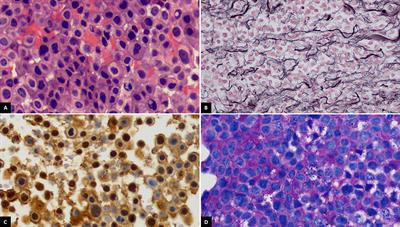 Aggressive Pituitary Macroadenoma Treated With Capecitabine and Temozolomide Chemotherapy Combination in a Patient With Nelson’s Syndrome: A Case Report